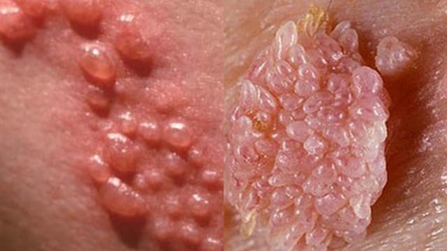 Bệnh sùi mào gà có lây qua quần áo không?
