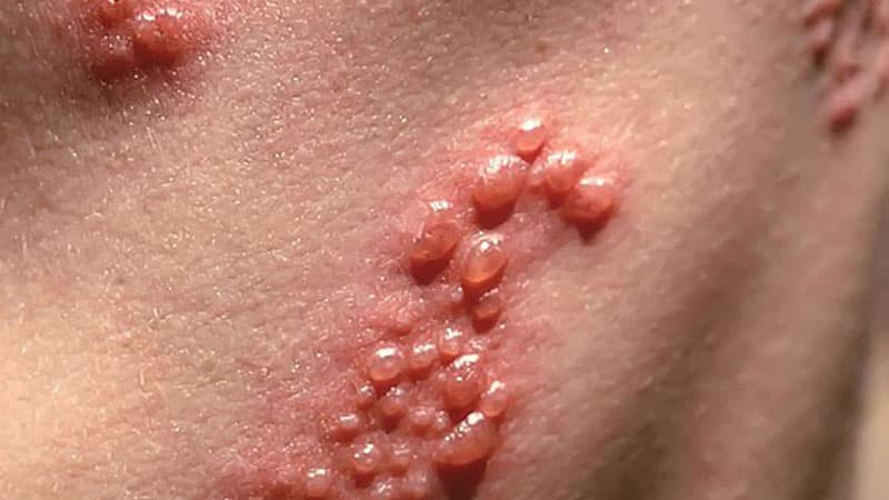mụn rộp sinh dục bao lâu thì khỏi