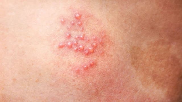 Bị mụn rộp sinh dục phải làm sao?