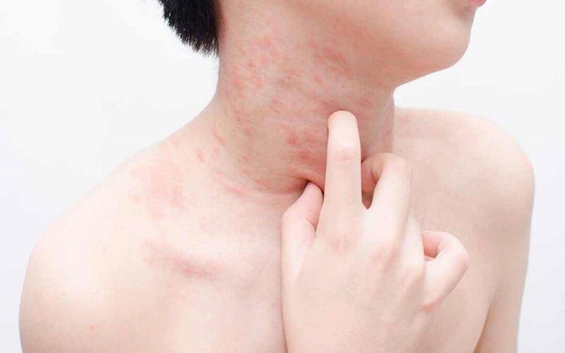 mề đay tái phát thường xuyên