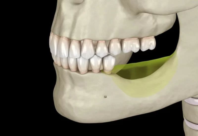 bị tiêu xương hàm có trồng răng được không