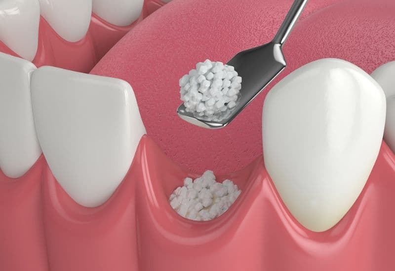 bị tiêu xương hàm có trồng răng được không