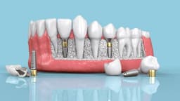 Bị tiêu xương hàm có trồng răng được không?