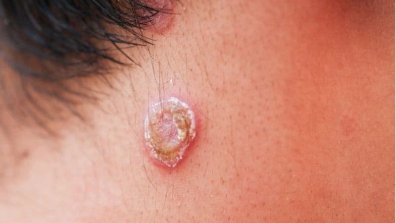bệnh giang mai ở nữ có chữa được không
