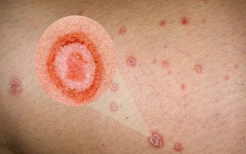 dấu hiệu bệnh giang mai giai đoạn 1