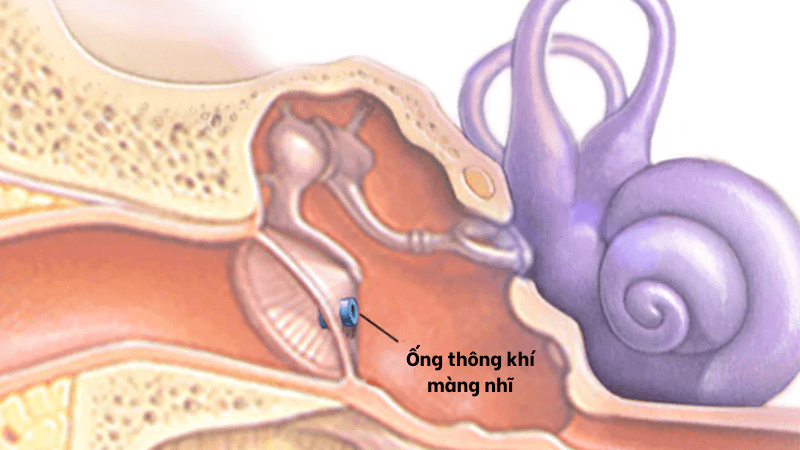 các loại ống thông khí màng nhĩ