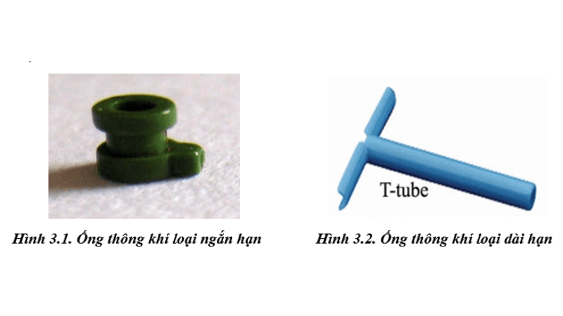 các loại ống thông khí màng nhĩ