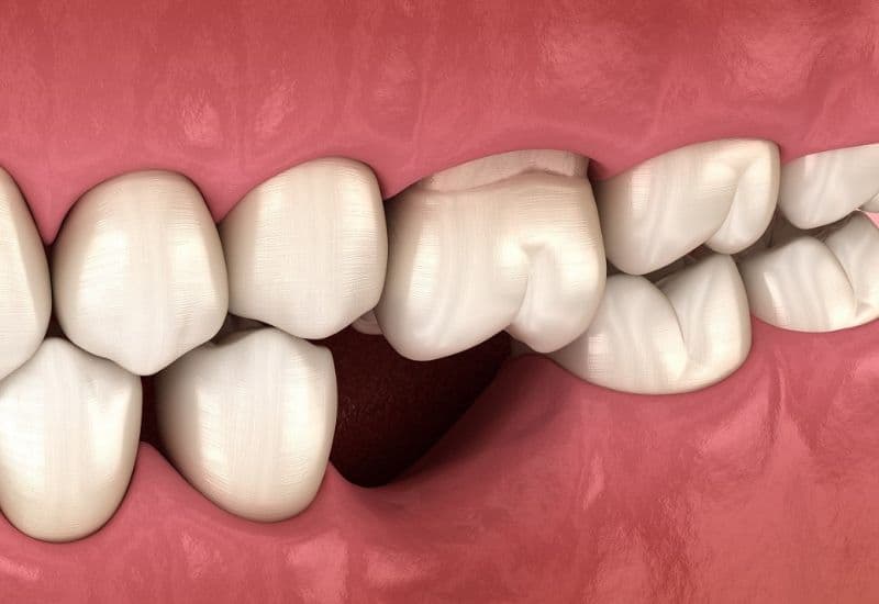 các phương pháp trồng răng