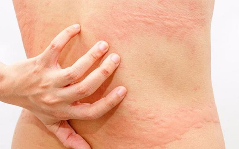 giảm ngứa do dị ứng