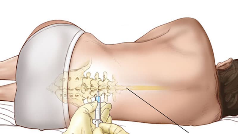 cách giảm đau lưng sau gây tê tủy sống