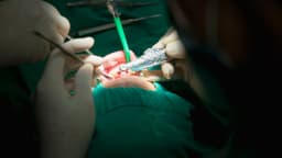Cắm trụ implant có đau không? Mất bao lâu?