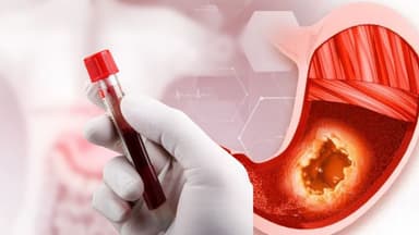 Những điều cần biết về các chỉ số tầm soát ung thư dạ dày