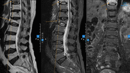 Chỉ định và quy trình chụp mri cột sống cổ tại Thu Cúc TCI