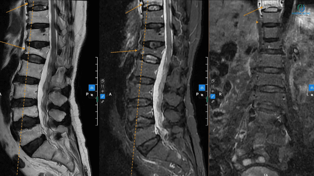 Chỉ định và quy trình chụp mri cột sống cổ tại Thu Cúc TCI