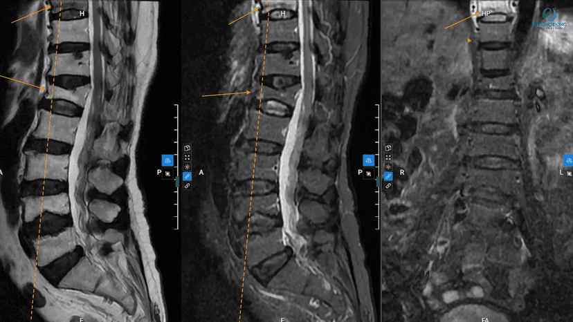 Chỉ định và quy trình chụp mri cột sống cổ tại Thu Cúc TCI