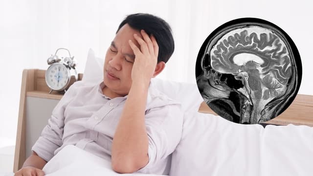 Khi nào cần chụp MRI não?