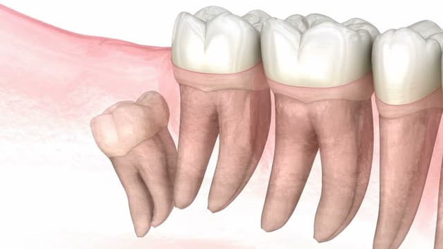 Có nên trồng răng số 8 không?