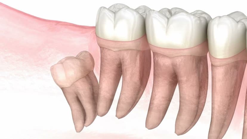 Có nên trồng răng số 8 không?