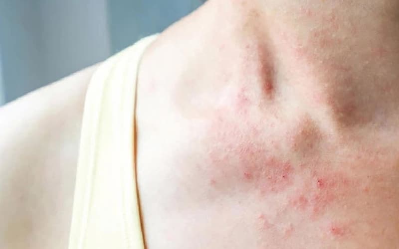 tinh dầu hoa anh thảo có tác dụng gì