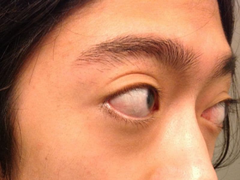 cường giáp ở trẻ em