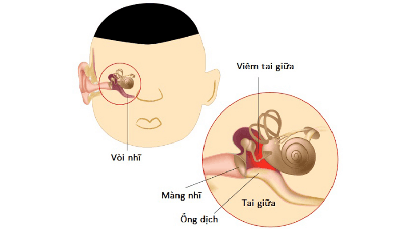 đặt ống thông khí màng nhĩ