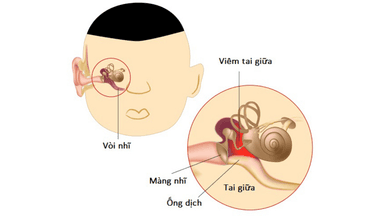 Chỉ định đặt ống thông khí màng nhĩ