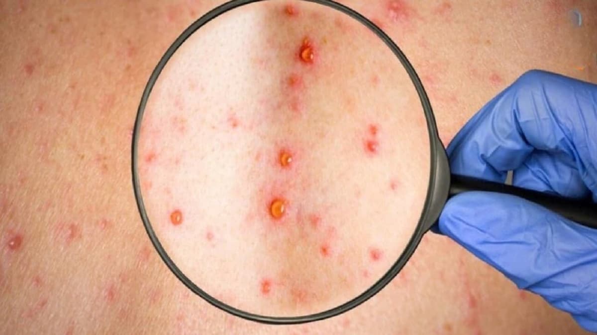 Dấu hiệu bệnh giang mai giai đoạn 1