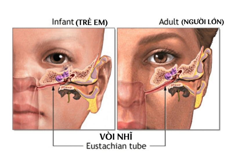 dấu hiệu tắc vòi nhĩ