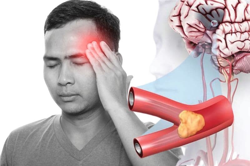 thiếu máu não biểu hiện như thế nào