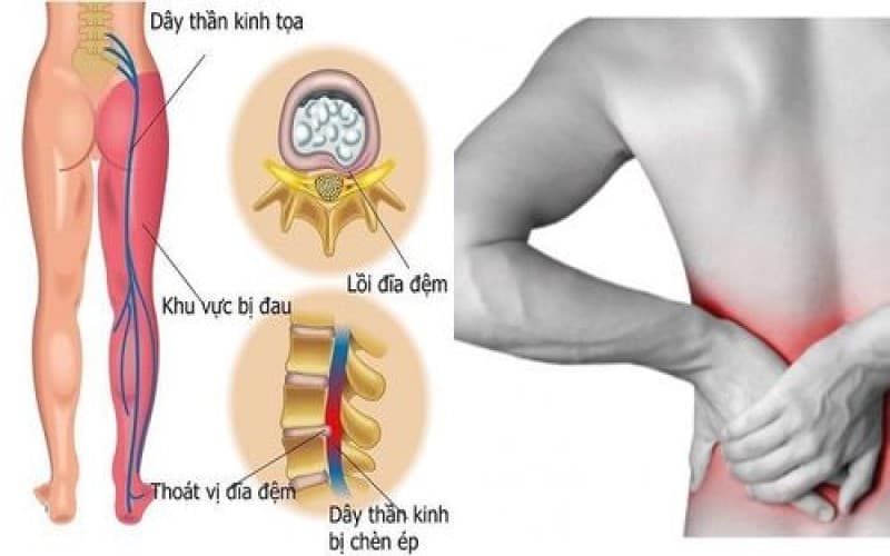 nguyên nhân gây thoát vị đĩa đệm cột sống