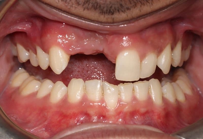 dấu hiệu tiêu xương răng