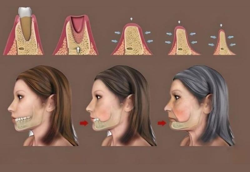 dấu hiệu tiêu xương răng
