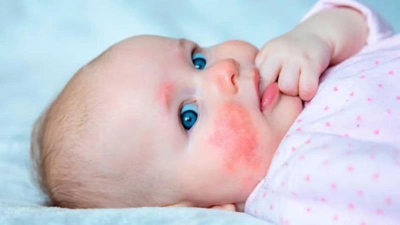 biểu hiện dị ứng đạm bò