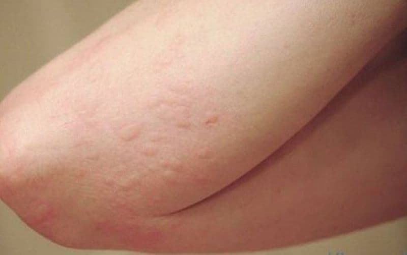 dị ứng gluten là gì