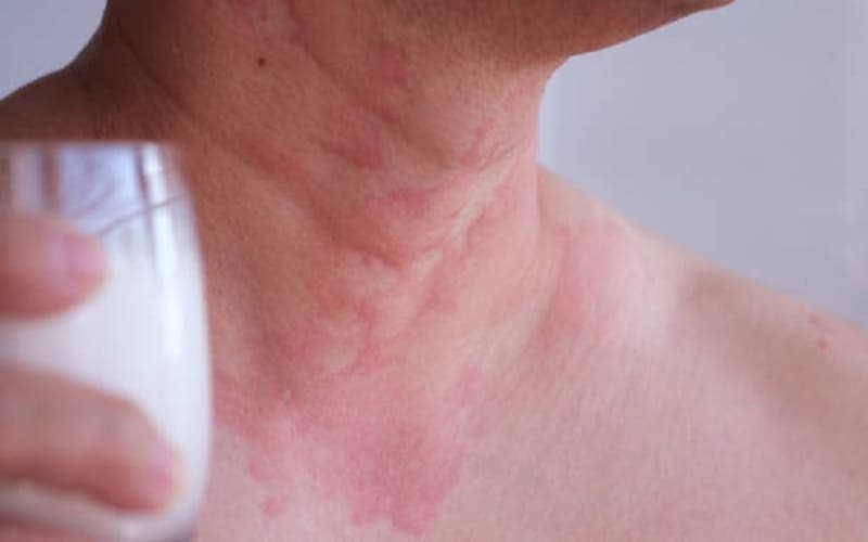 dị ứng đạm sữa bò ở người lớn
