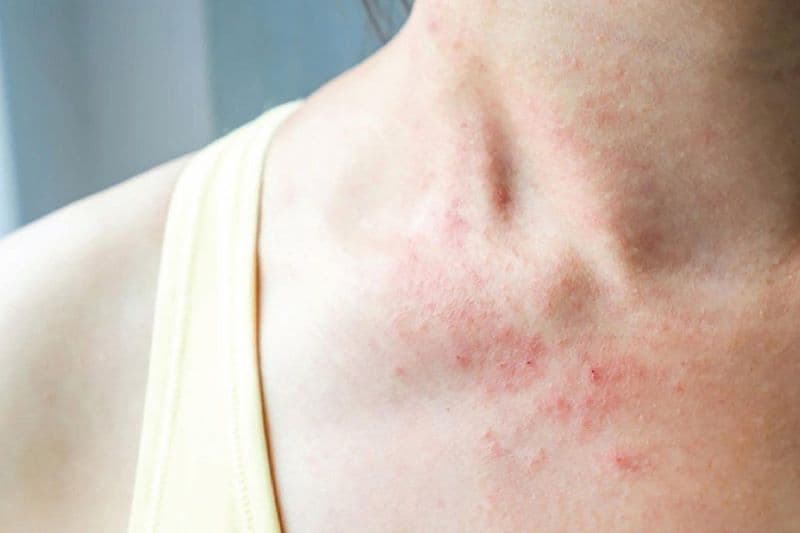 phác đồ điều trị viêm da tiếp xúc dị ứng