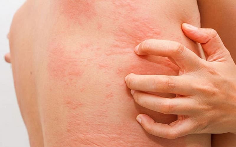 hình ảnh nổi mề đay do gan