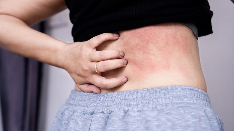 hình ảnh nổi mề đay do gan