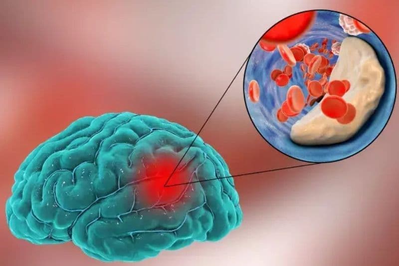 nhồi máu não có phải là đột quỵ không