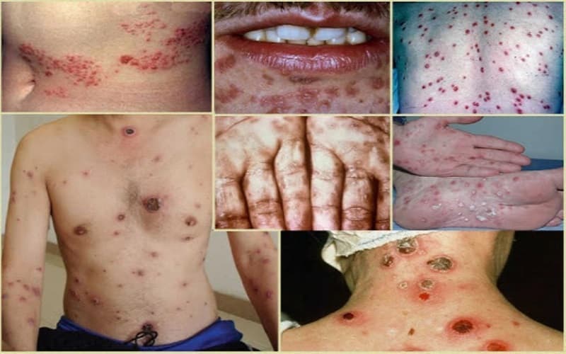 dấu hiệu bệnh giang mai giai đoạn 1