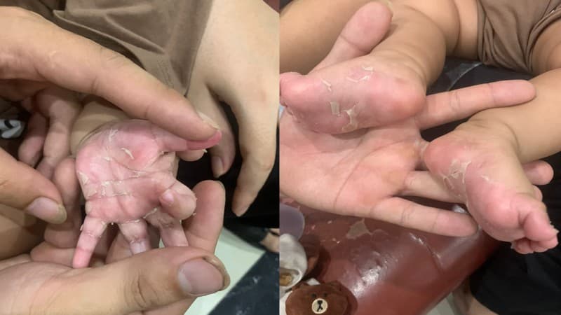 bệnh giang mai bẩm sinh có chữa được không