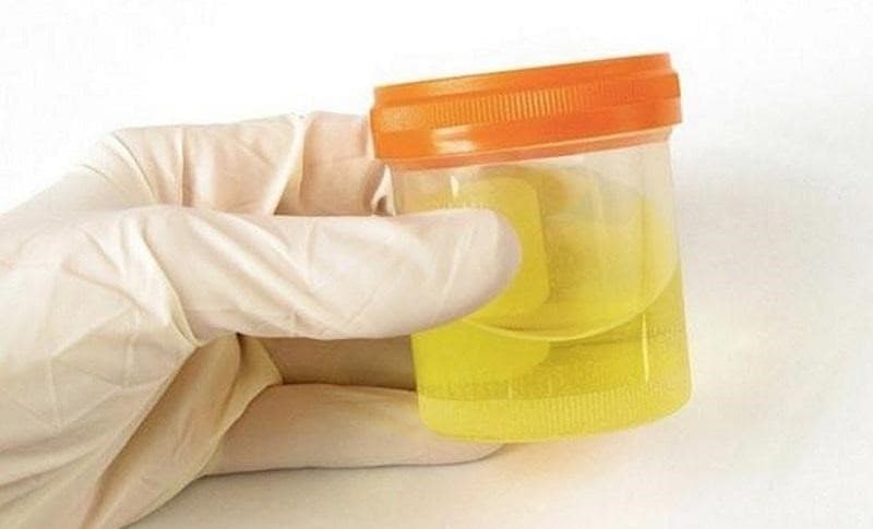 màu nước tiểu suy thận