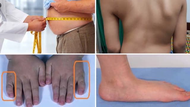 Hội chứng siêu nam có nguy hiểm không?