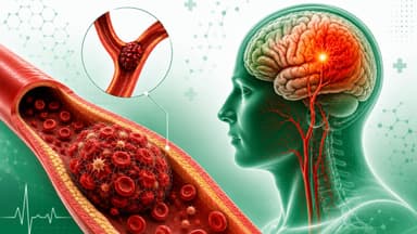Huyết khối gây đột quỵ như thế nào? Làm sao để phòng ngừa