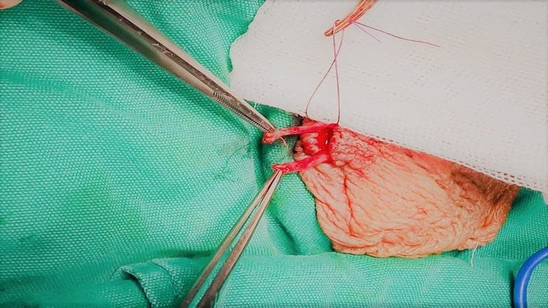 thắt ống dẫn tinh có xuất tinh được không