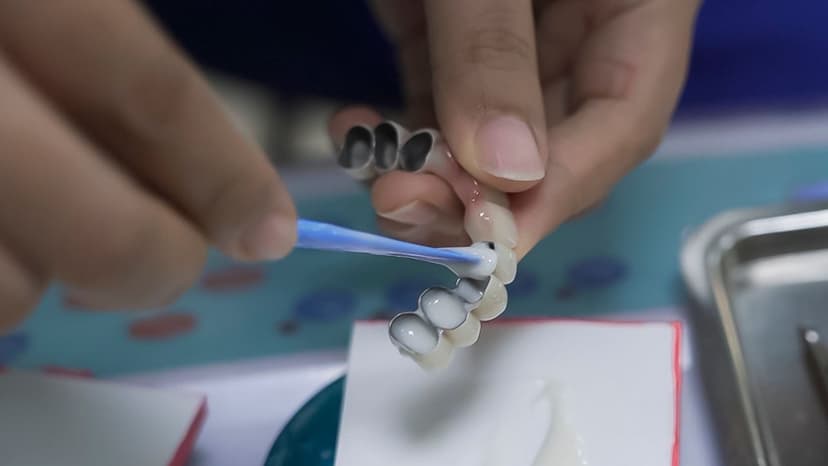 Làm cầu răng sứ có bị tiêu xương không?