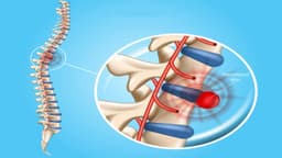 Làm gì khi bị thoát vị đĩa đệm?