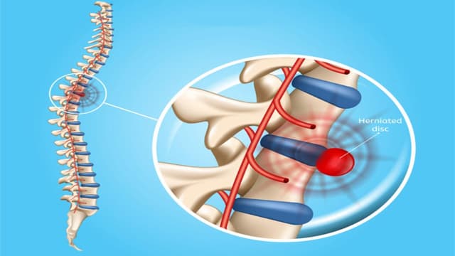 Làm gì khi bị thoát vị đĩa đệm?