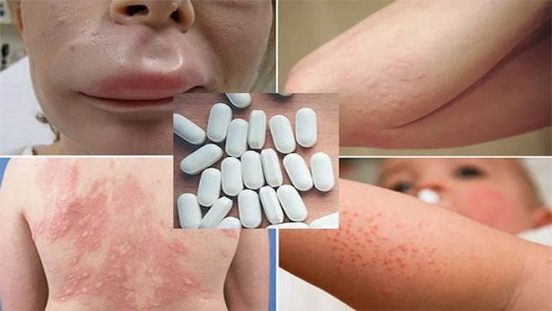 làm sao biết mình dị ứng thuốc gì