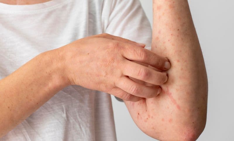 uống rượu bị dị ứng mẩn đỏ